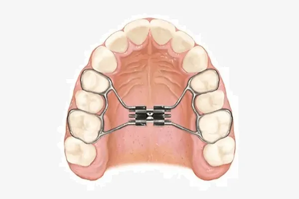 disyuntor en ortodoncia