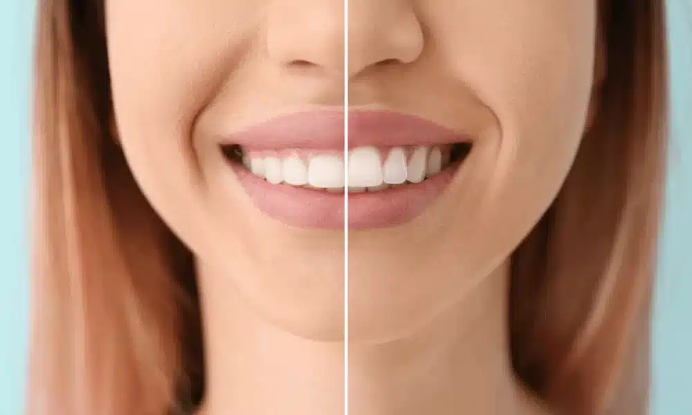 gingivectomía estética