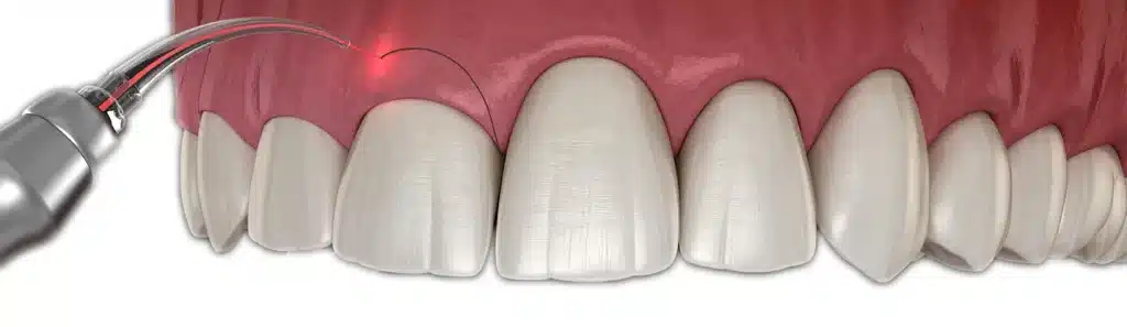 gingivectomía estética encías