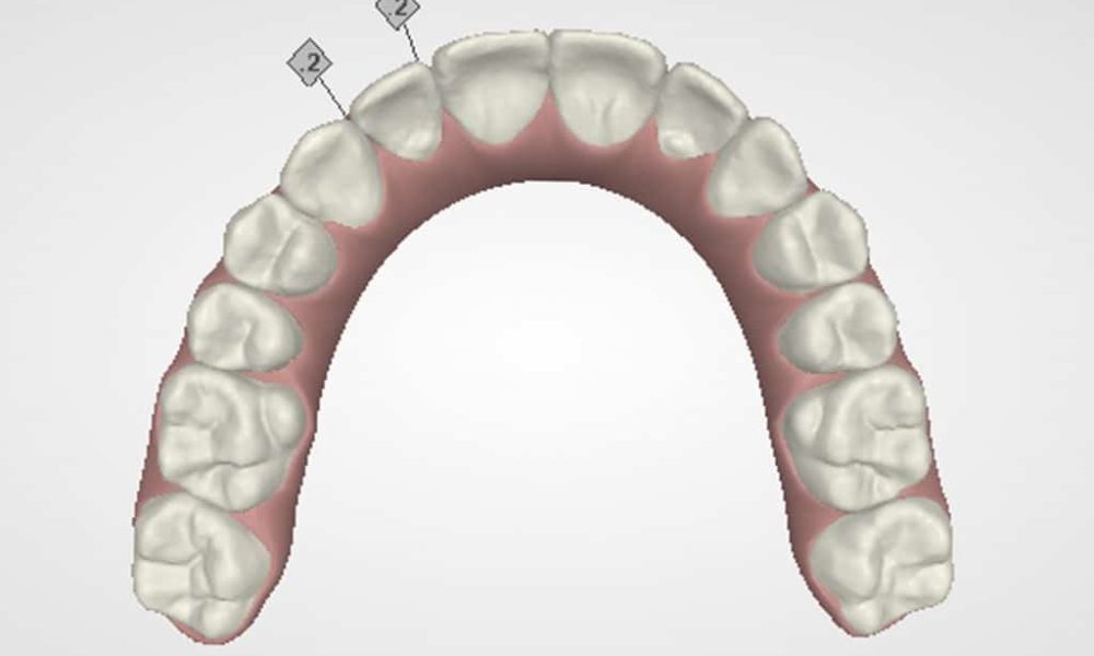 Stripping en la Ortodoncia con Invisalign