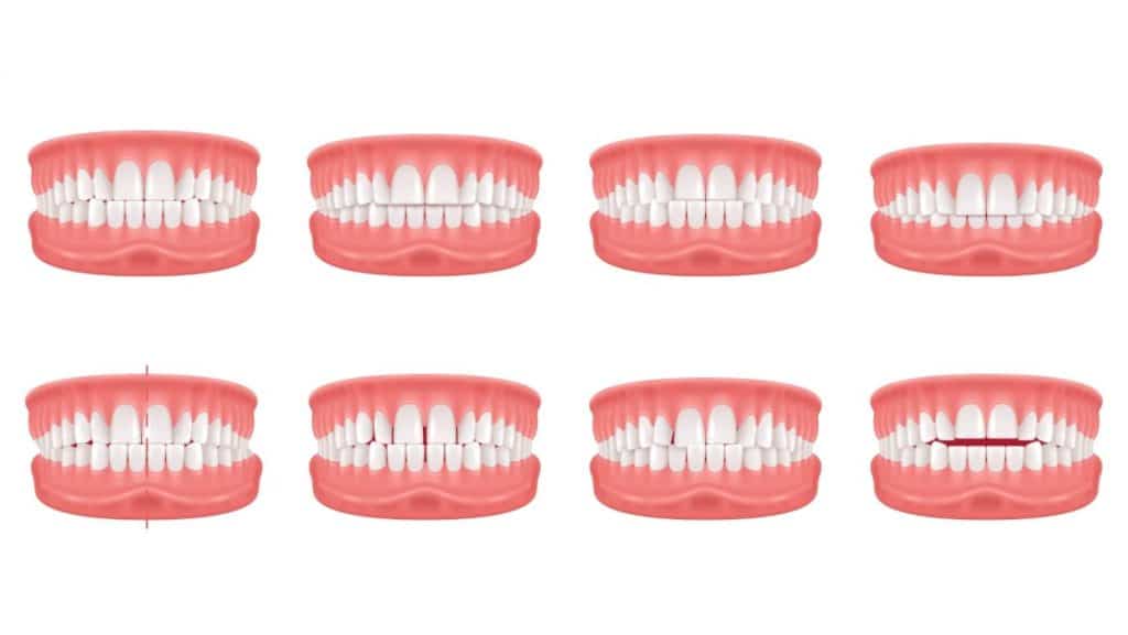 Tipos de Problemas de Mordida que se Pueden Corregir con Invisalign